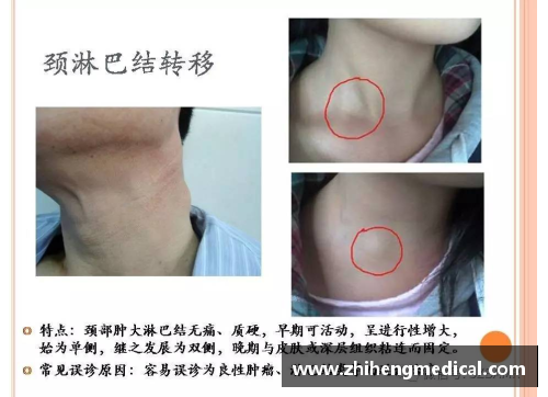 bifa必发广东医生发现鼻咽癌动态预后风险分子指标，开启早期诊疗新局面